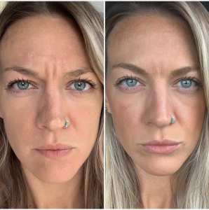 Botox glabella lines