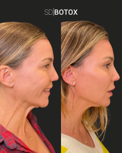 Botox neck bands