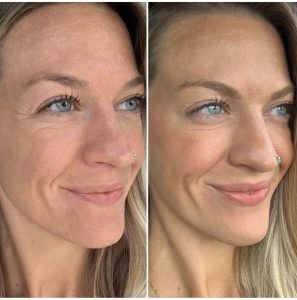 Botox Before and after photos